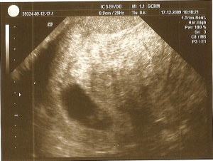 Teresalsfirstscan Pics 022 17th dec 09.jpg