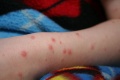 Chickenpox.jpg