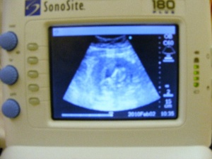 Teresals3rdscan Pics.JPG